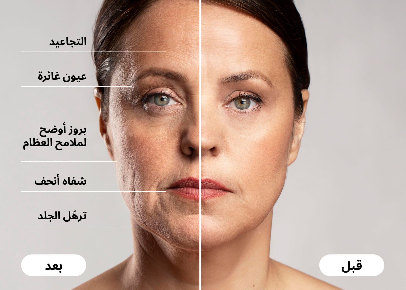 Person showing facial volume loss associated with GLP-1 injections (Ozempic face)